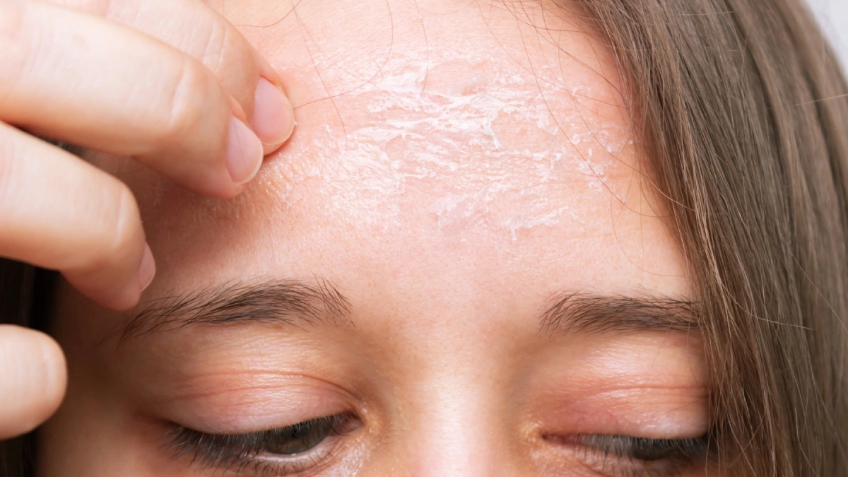 Preventive Measures and Solutions Against Peeling