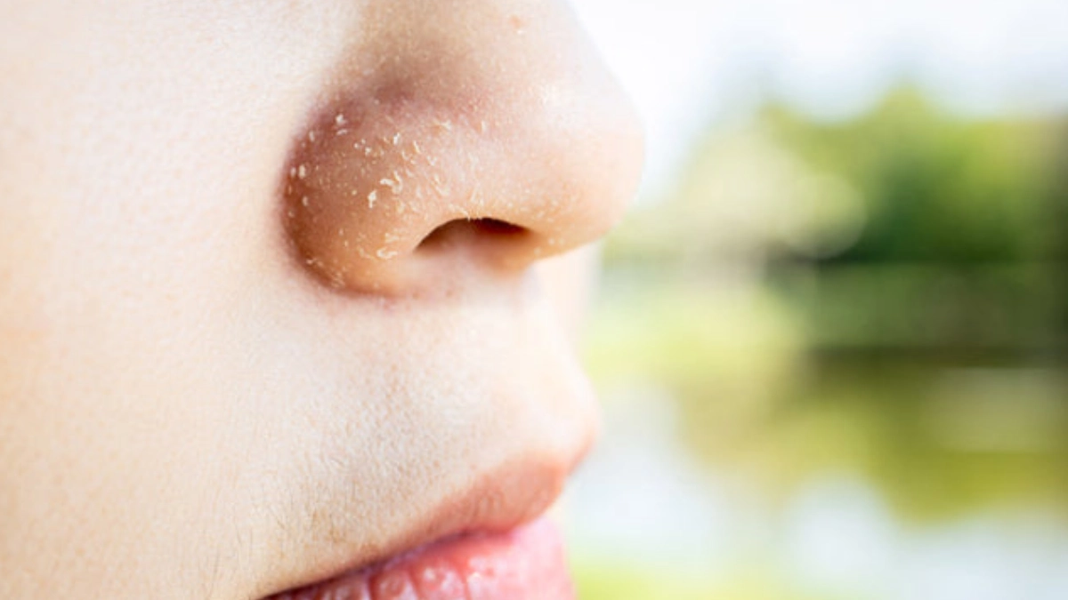 Treatment methods for skin peeling on the nose