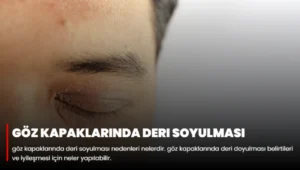 Göz Kapaklarında Deri Soyulması Nedenleri