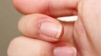 Parmak Uçlarında Deri Soyulması Nedenleri ve Tedavisi